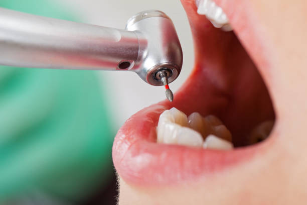 Best Dental Abscess Treatment in Huachuca City, AZ